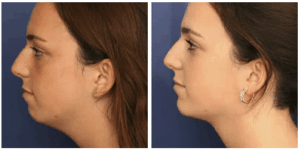 Before and after image of a young woman who had neck surgery from Dr. Schuster for a more defined neck and jawline